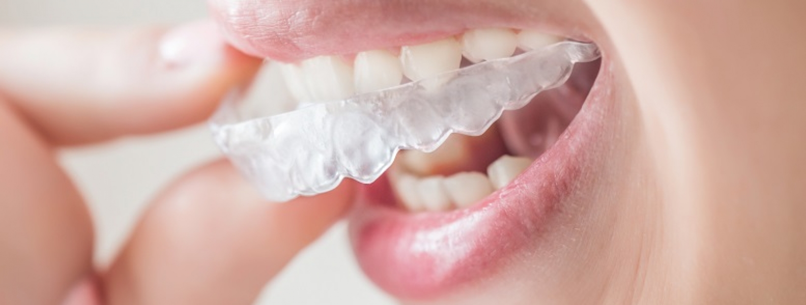 Bruksizm – przyczyny, objawy, leczenie bruksizmu