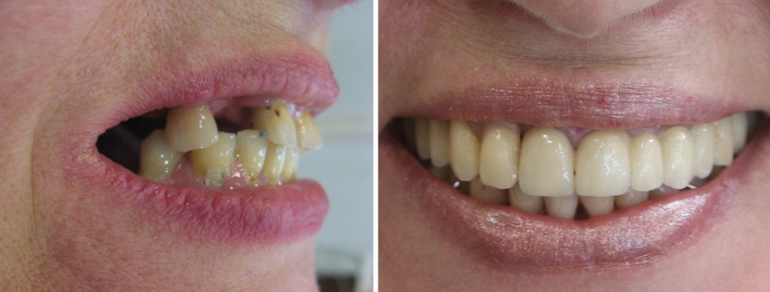 Stomatologia estetyczna przed i po transformacji